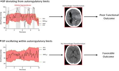 Hemodynamics and Hemorrhagic Transformation After Endovascular Therapy for Ischemic Stroke